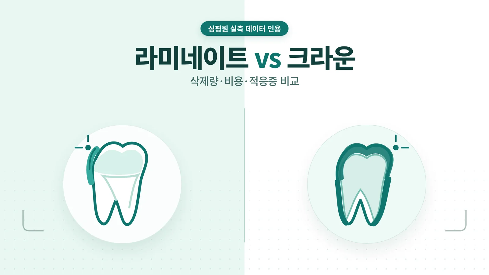 라미네이트와 크라운 비교